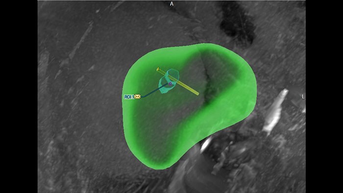 magnetic resonance dynacad prostate