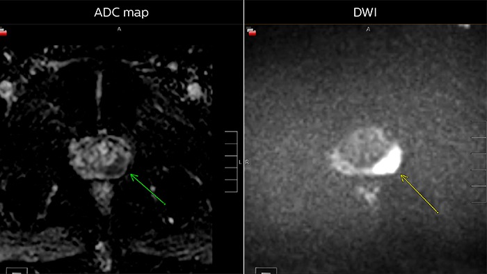 Images from multiparametric MRI of a classic peripheral zone lesion in the prostate