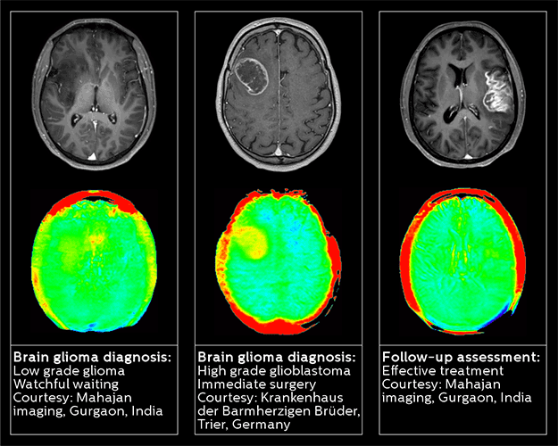 3d apt neuro oncology