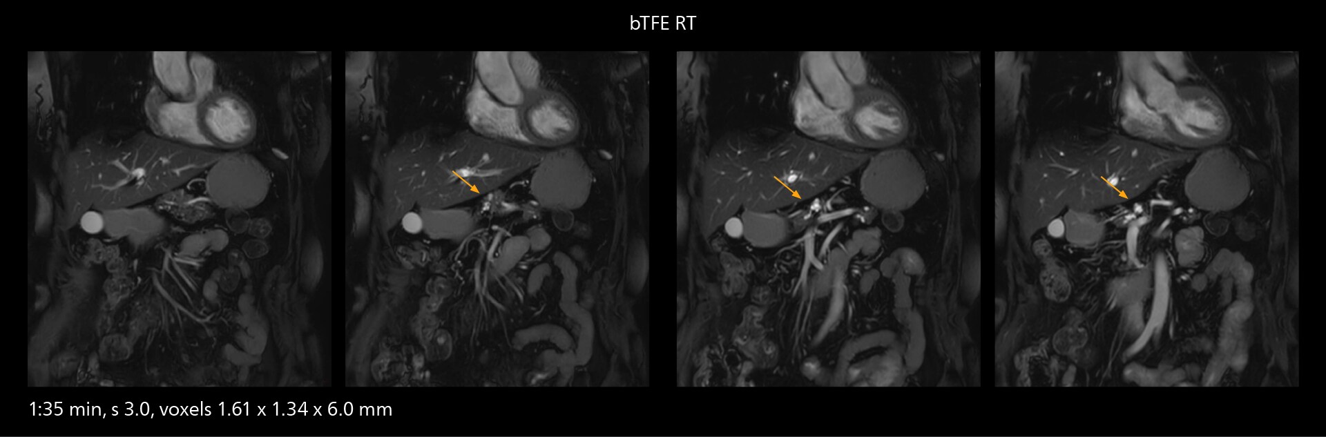 Mrcp mri two