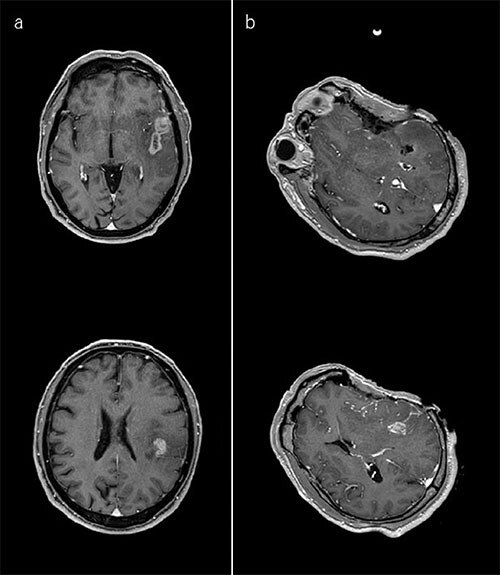 Surgical decision mri