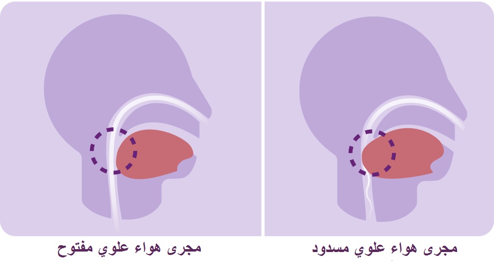 مجرى هواء علوي مفتوح و مجرى هواء علوي مسدود