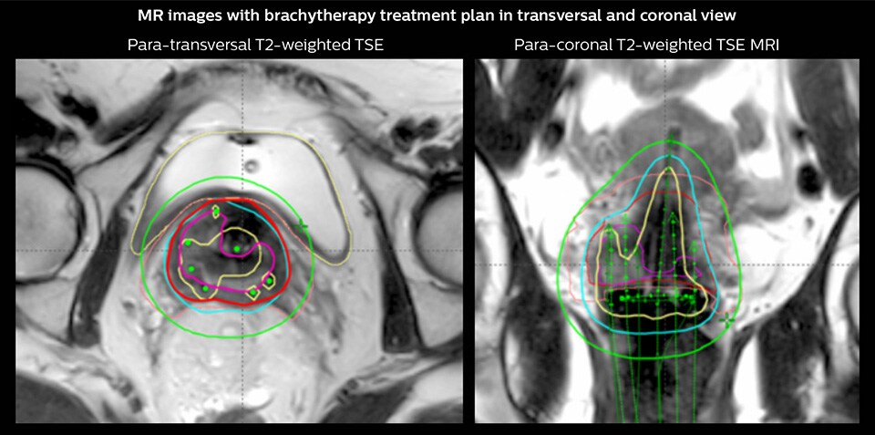 magnetic resonance images with brachytherapy treatment plan in transversal and coronal view