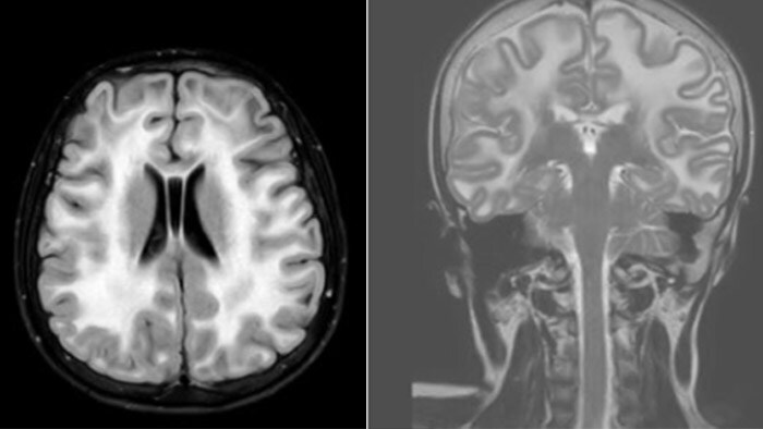 Leukodystrophy in a teenager