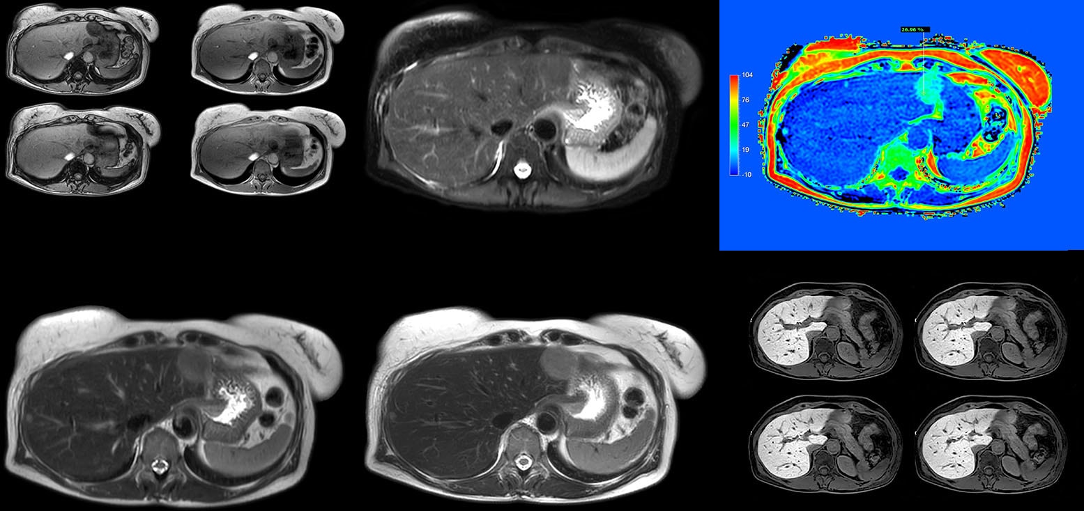 fieldstrength liver mr clinical case 2