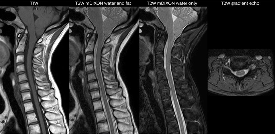 cervical spine mri in ed