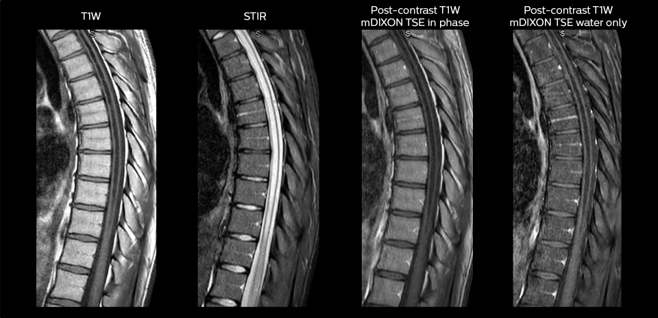 mri in ed myelopathy