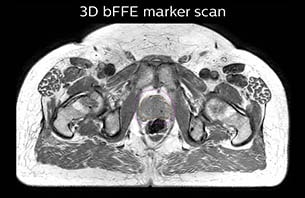 Turku MRI-marker scan therapy case 3