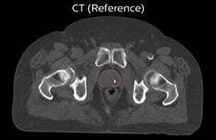 Turku CT reference case 5