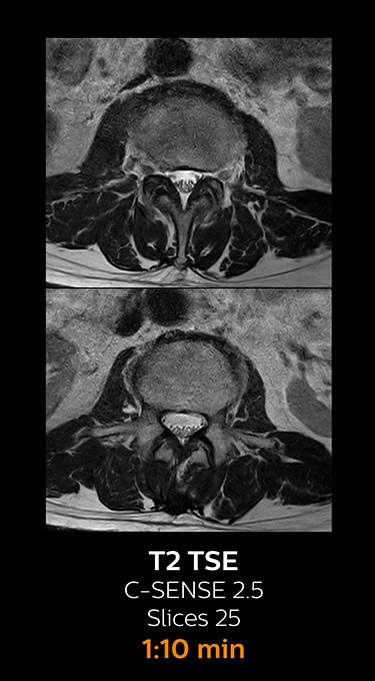 T2 TSE magnetic resonance imaging