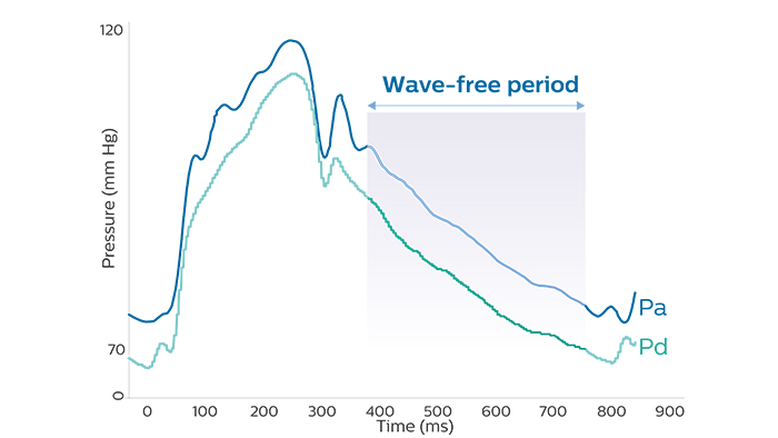 Distal Coronary Pressure