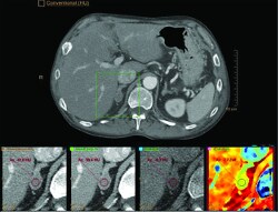 Adrenal iqon spectral computed tomorgraphy image