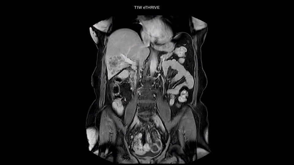 Bremen Clinical case liver MRI