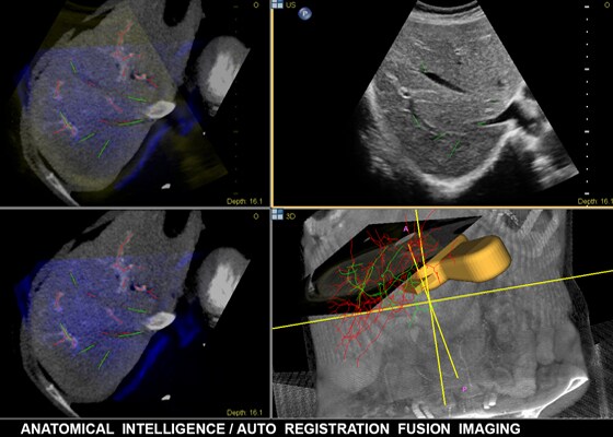 Fusion Registeration L